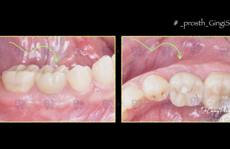 GIA TĂNG MÔ MỀM VÀ PHỤC HÌNH TRÊN IMPLANT