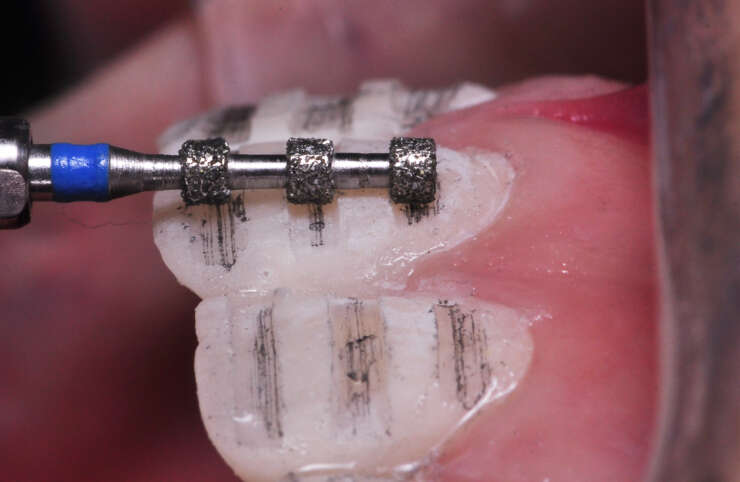 MẶT DÁN SỨ VÀ THIẾT KẾ NỤ CƯỜI