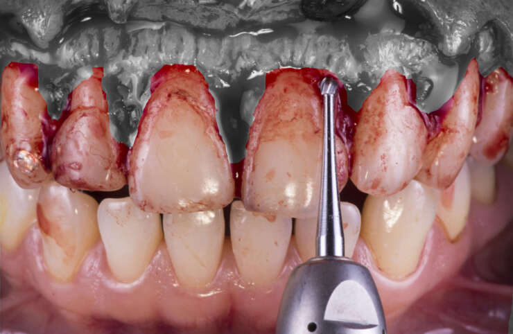 PHẪU THUẬT NƯỚU LÀM DÀI THÂN RĂNG